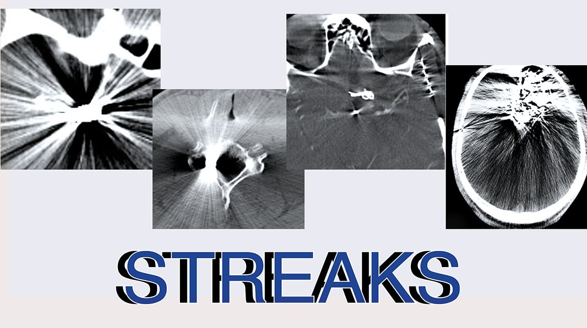 What Causes Streak Artifact In Ct